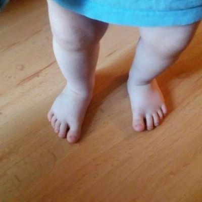 Плоско-вальгусная деформация стоп у ребенка. Нужно ли бояться диагноза?